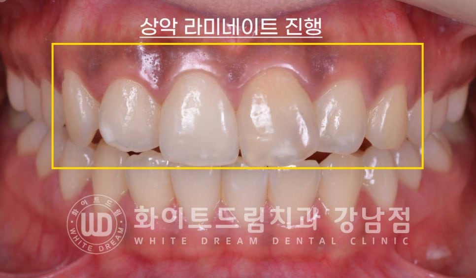 신경치료 후 변색된치아, 라미네이트로 변색과 모양까지 개선! / 강남역화이트드림치과 관련 이미지 8