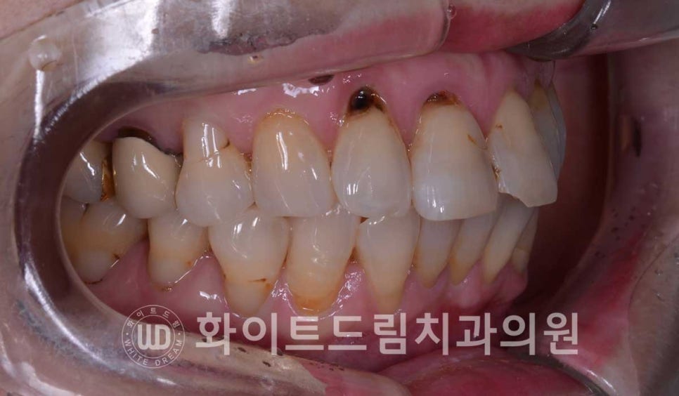 신논현라미네이트, 중년 충치치료, "치경부 우식증, 라미네이트로 당일 치료 OK" 관련 이미지 6