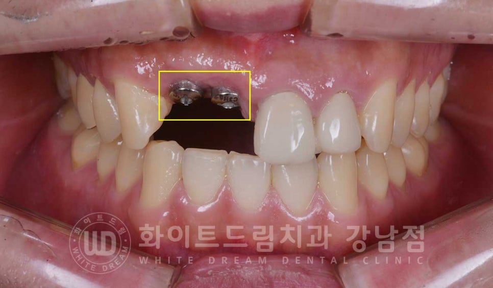 앞니 임플란트 사례 "예전에 심은 임플란트를 뺐어요. 재수술 가능할까요?" 관련 이미지 8