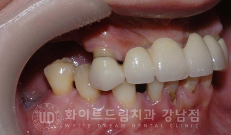 치주염 전체임플란트 치료 사례 / 치아를 흔들리게 만드는 치주염이란? 관련 이미지 15