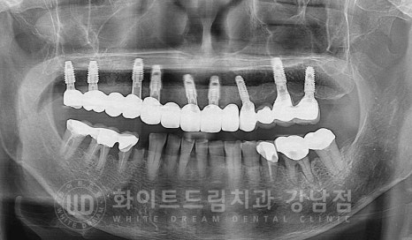임플란트 1차 수술, 2차 수술이란 무엇일까? (+ 상악 전체 임플란트 치료 기간) 관련 이미지 15