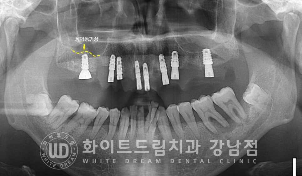 40대 전체임플란트 / 디지털스캔바디를 이용한 전체 임플란트 치료 사례 (Feat. 치주염) 관련 이미지 11