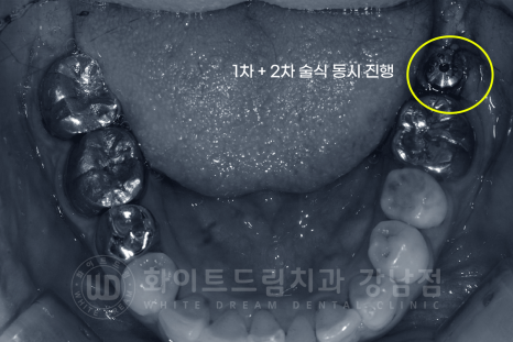 강남역 어금니 임플란트 "어금니가 부러졌어요" 상악동 거상술(lateral approach) 관련 이미지 9
