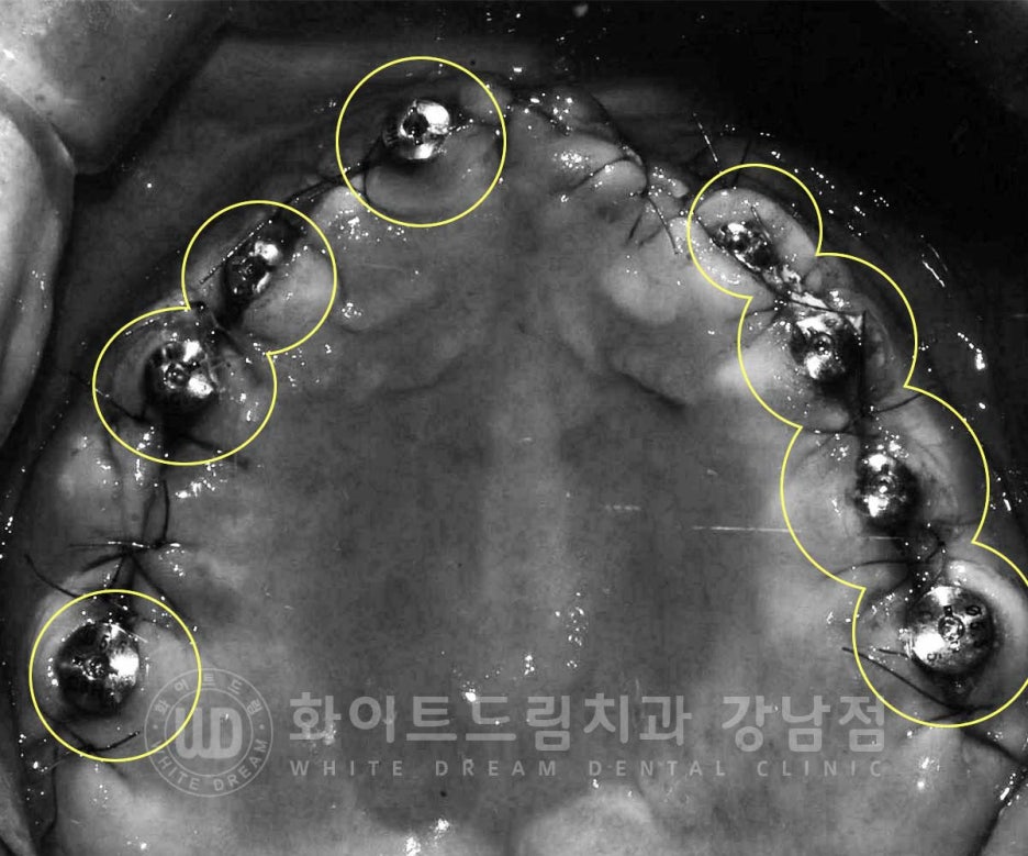 Gangnam Station Dental Clinic Specializing in Implant Revision Surgery—Revision Surgery and Full-Mouth Implant Treatment at the Same Time! image 8