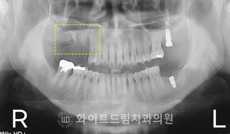 강남역치과 임플란트 "발치 후 바로 임플란트가 가능한 경우 vs 기다려야 하는 경우" 관련 이미지 8