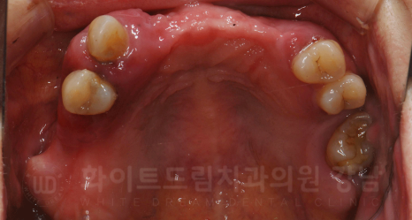 강남역 임플란트 치과 "틀니가 안 맞아서 불편해요" 틀니 → 전체 임플란트로! 관련 이미지 6