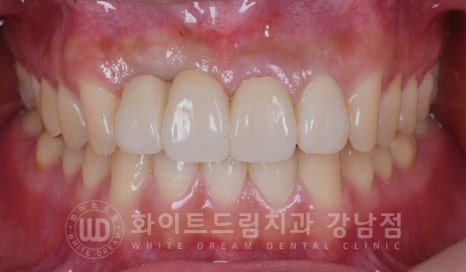 앞니 임플란트 사례 "예전에 심은 임플란트를 뺐어요. 재수술 가능할까요?" 관련 이미지 3