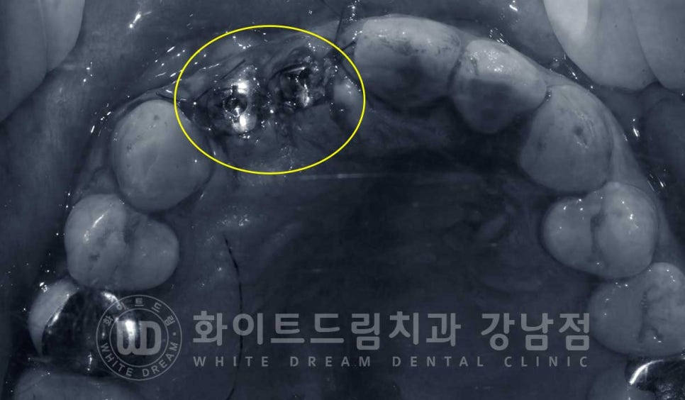 앞니 임플란트 사례 "예전에 심은 임플란트를 뺐어요. 재수술 가능할까요?" 관련 이미지 7