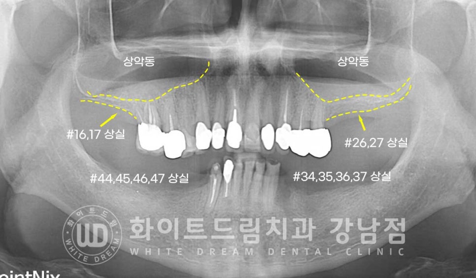 임플란트 개수를 줄일 수 있는 방법? (+치아를 발치한지 오래되었나요?) 관련 이미지 4