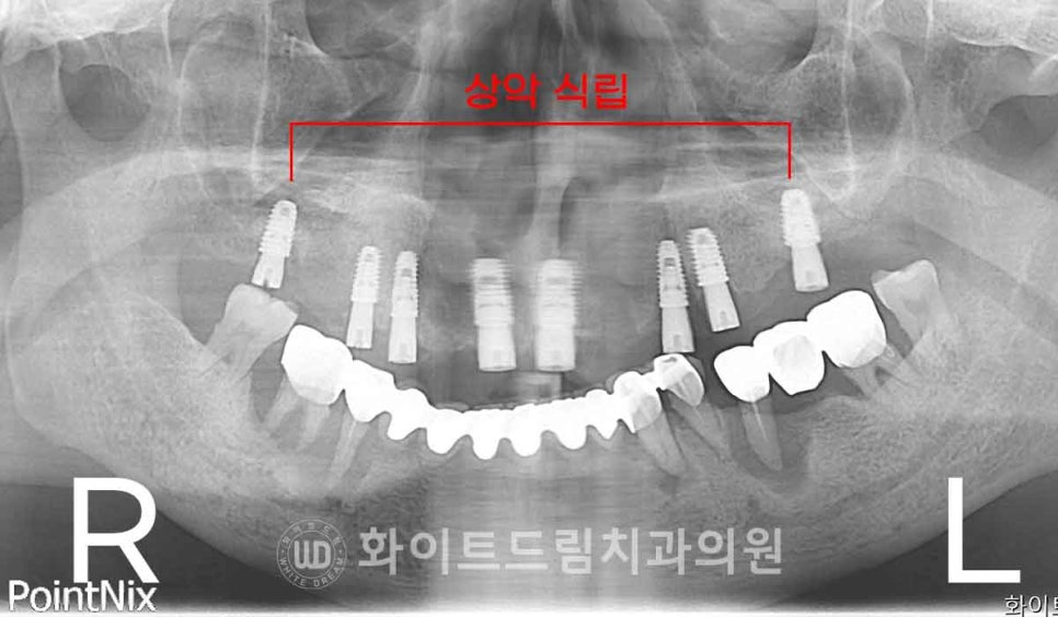 서울전체임플란트잘하는치과, 왜 치주염이 심해지면 반대교합까지 생길까요? (치주염 전체 임플란트 CASE) 관련 이미지 14