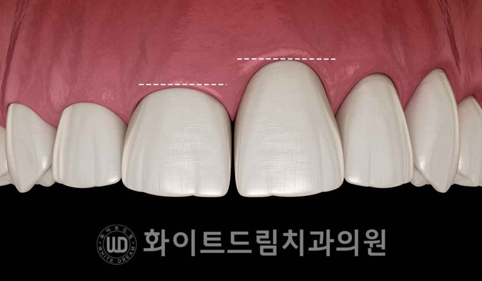 강남역 잇몸성형, 라미네이트와 흔히 동반되는 관련 이미지 2