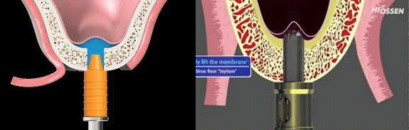 서초동 어금니 임플란트 / 강남역 화이트드림치과 : 상악동 거상술 (crestal approch) 관련 이미지 10