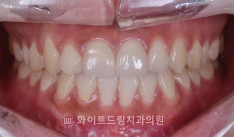 강남역앞니치과 / "신경치료한 치아가 누렇게 변했어요." 신경치료 후 변색된 치아, 어떻게 치료하나요? 관련 이미지 16