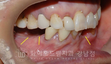 잇몸뼈가 없다는 게 무슨 말일까? "틀니를 오래 사용해서 잇몸뼈가 없대요" 임플란트 잘하는 강남치과 관련 이미지 4
