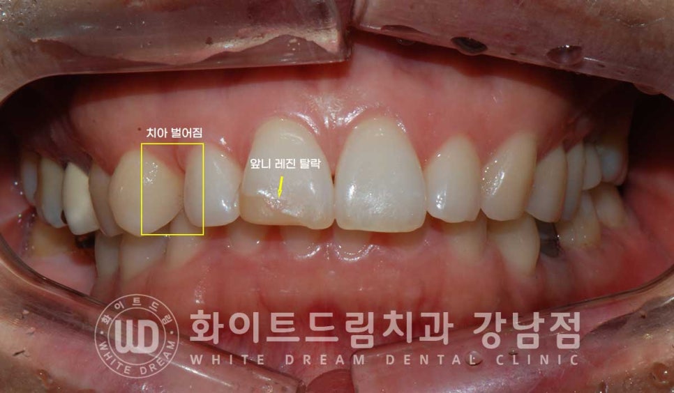 앞니 원데이라미네이트 / 떨어진 앞니 레진 & 벌어진 앞니, 라미네이트로 당일 개선 ★ 관련 이미지 4
