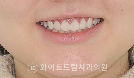 강남역 잇몸성형, 라미네이트와 흔히 동반되는 관련 이미지 14