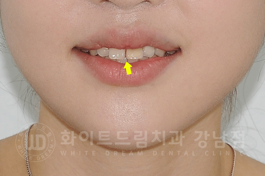 강남역 주변 치과 "10년 된 앞니가 변색됐어요" 앞니 심미 치료 관련 이미지 5