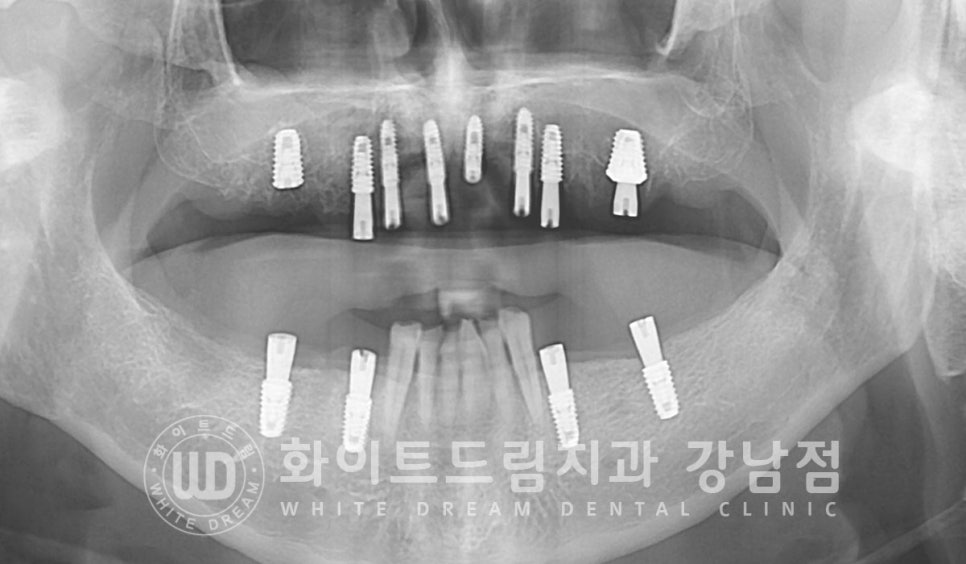 상악 풀케이스임플란트 사례 / "지인 추천으로 인천에서 왔어요." 관련 이미지 12