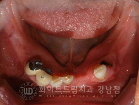 잇몸뼈가 없다는 게 무슨 말일까? "틀니를 오래 사용해서 잇몸뼈가 없대요" 임플란트 잘하는 강남치과 관련 이미지 11