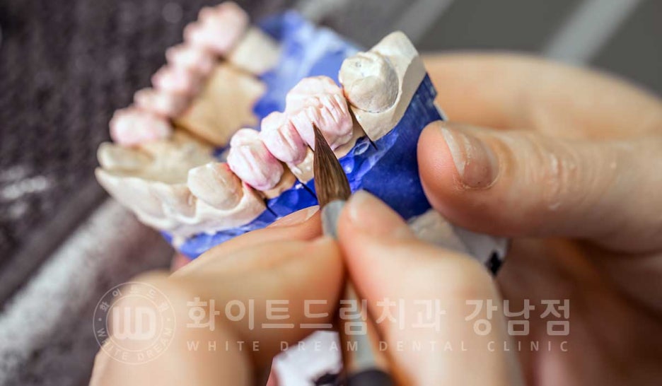 앞니라미네이트 교체 "5년 전에 한 라미네이트가 뻗쳐 보여요" 예쁘게 치료할 수 있나요? 관련 이미지 11