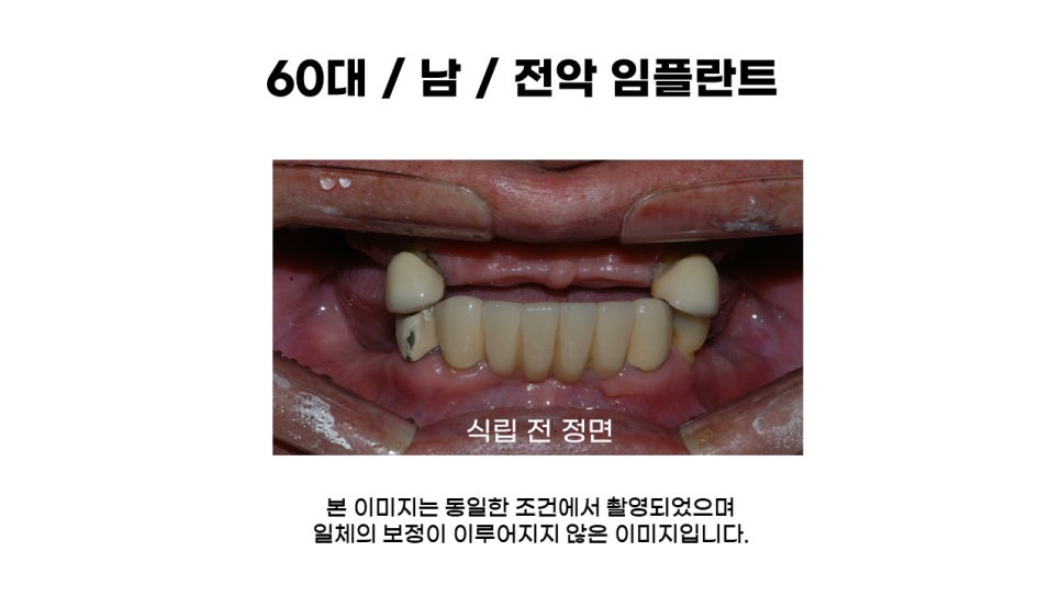 60대 전악임플란트후기 및 치료기간 관련 이미지 1
