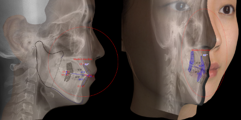 치아교정, 꼭 해야 한다면 미리 알아 두자. 관련 이미지 30
