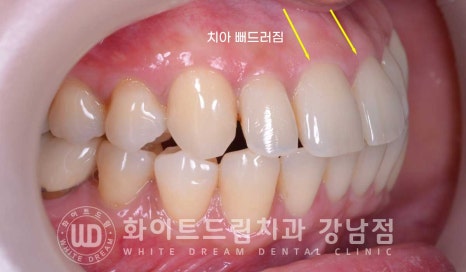 앞니 뻐드러짐 라미네이트 "뻐드러지고 벌어진 앞니" 당일 라미네이트 치료 case 관련 이미지 6