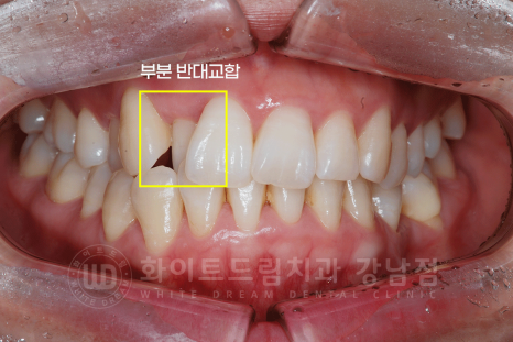 강남 덧니 비발치교정 / 임플란트와 치아교정 동시 진행 case 리뷰. 관련 이미지 6