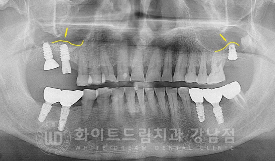 [흔들리는 어금니크라운] 흔들리고 냄새나는 오래된 크라운, 원인은? 관련 이미지 8