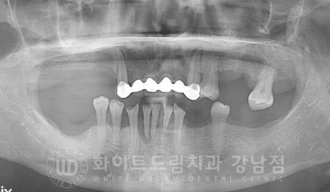 치주염 전체임플란트 치료 사례 / 치아를 흔들리게 만드는 치주염이란? 관련 이미지 19