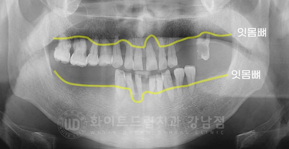 강남역 전악 임플란트 "치아가 흔들리고 빠져요!" 치주염 임플란트 치료 관련 이미지 5
