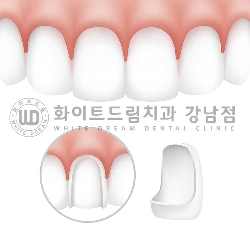 중년 앞니라미네이트 / 노화로 마모되고 누렇게 변한 치아, 어떻게 치료할까? 관련 이미지 9