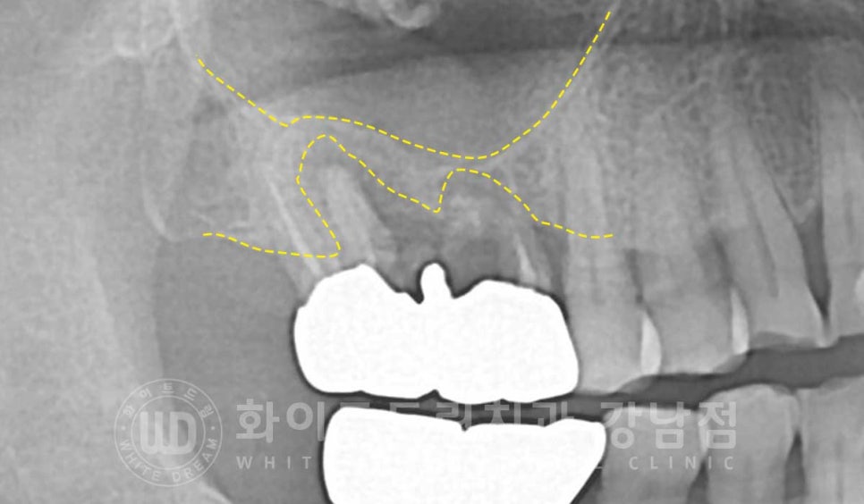 [흔들리는 어금니크라운] 흔들리고 냄새나는 오래된 크라운, 원인은? 관련 이미지 6