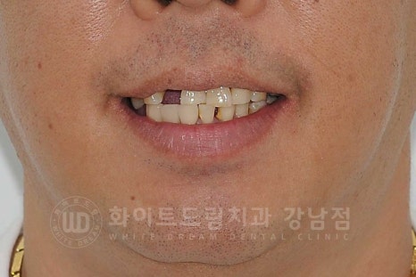 상악동거상술 잘하는치과, 강남역 화이트드림치과 상악동 함기화로 인한 거상술 치료 리뷰 관련 이미지 4