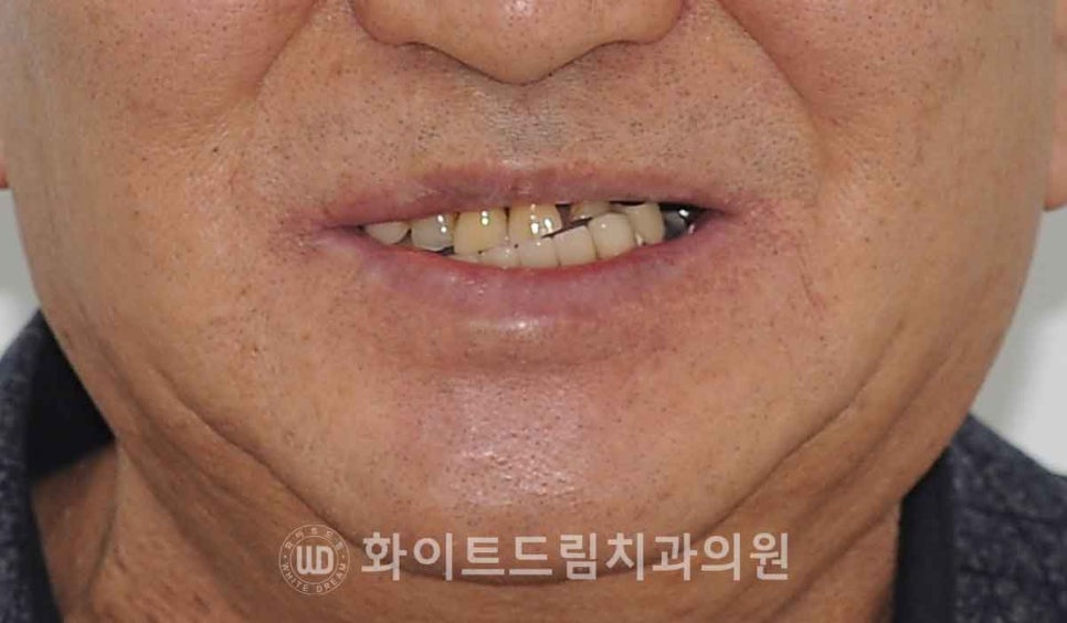 서울전체임플란트잘하는치과, 왜 치주염이 심해지면 반대교합까지 생길까요? (치주염 전체 임플란트 CASE) 관련 이미지 4