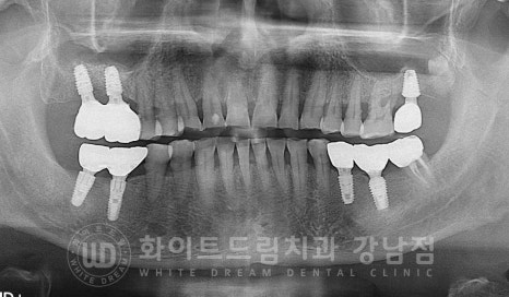 [흔들리는 어금니크라운] 흔들리고 냄새나는 오래된 크라운, 원인은? 관련 이미지 4