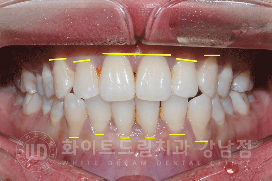 강남역 원데이 라미네이트 "유튜브 촬영하는데 치아가 신경 쓰여요" #강남화이트드림치과 관련 이미지 11