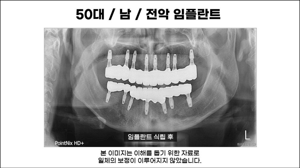 전체임플란트, 치료, 종류, 수술과정과 방법 관련 이미지 4