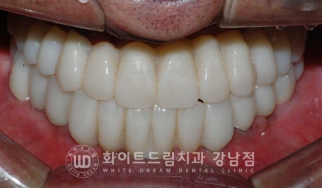 치주염 전체임플란트, 염증으로 인한 상악동 천공 & 신경관 가까이 녹은 잇몸뼈. 임플란트 식립 가능할까? 관련 이미지 21