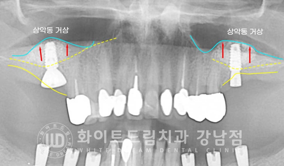 임플란트 개수를 줄일 수 있는 방법? (+치아를 발치한지 오래되었나요?) 관련 이미지 11