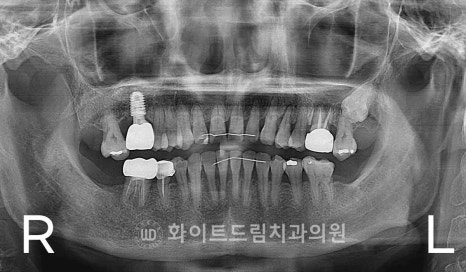 강남역어금니임플란트 치료 시 흔히 동반되는 상악동거상술 (Lateral window 방식), "잘 됐는지 어떻게 확인하죠?" 관련 이미지 13