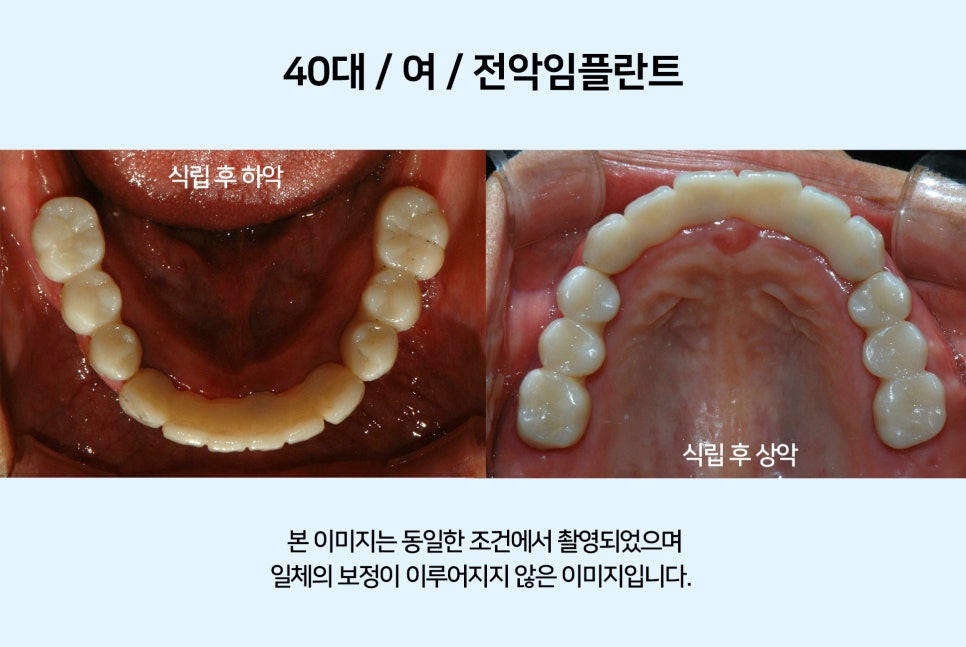 40대 전악 임플란트 식립 증례 관련 이미지 7