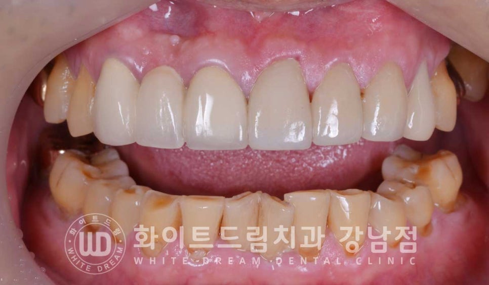 앞니 충치 라미네이트 치료 / "옆 크라운과 치아 색상을 맞추고 싶어요" 관련 이미지 13