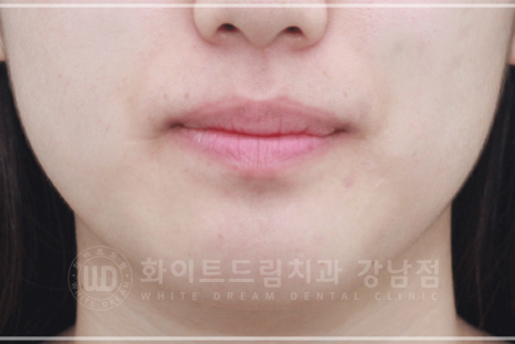 강남 덧니 비발치교정 / 임플란트와 치아교정 동시 진행 case 리뷰. 관련 이미지 26