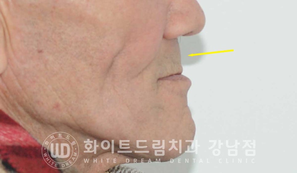 전체 임플란트 치료 기간과 수술 후 나타나는 변화는? 관련 이미지 18