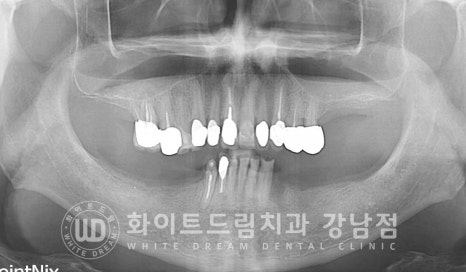 임플란트 개수를 줄일 수 있는 방법? (+치아를 발치한지 오래되었나요?) 관련 이미지 1