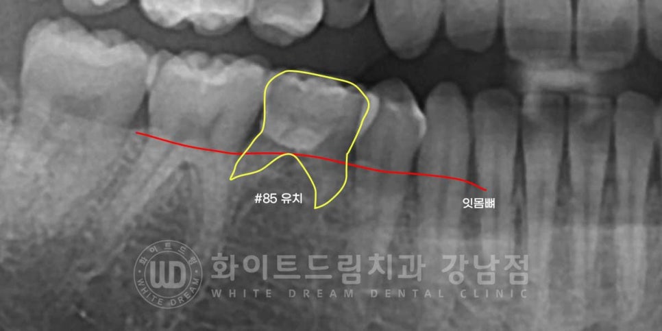 영구치 결손, "유치가 흔들려요." 성인 잔존 유치 발치 후 바로 임플란트 식립! 관련 이미지 2