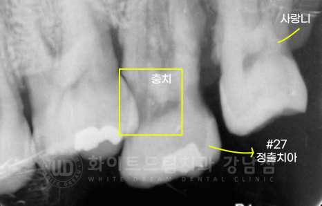 서초동 어금니 임플란트 / 강남역 화이트드림치과 : 상악동 거상술 (crestal approch) 관련 이미지 7