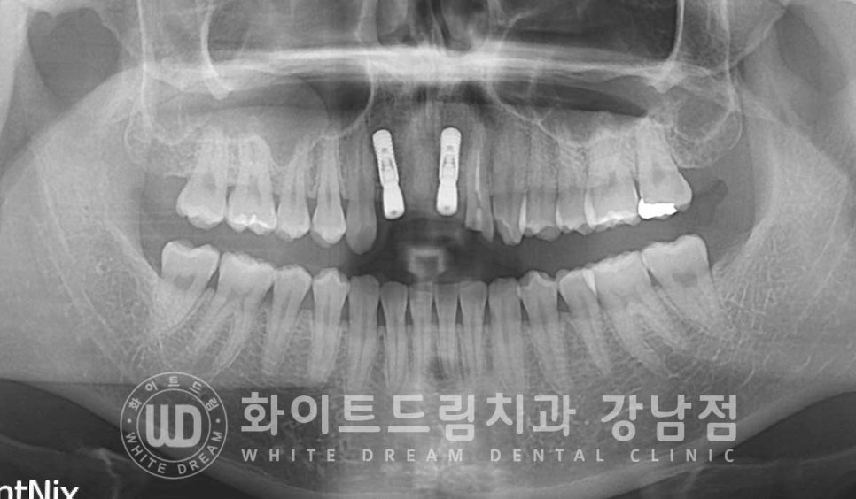 앞니 빠짐 임플란트 / 사고로 인한 앞니 탈구. 앞니 임플란트 치료는? 관련 이미지 6