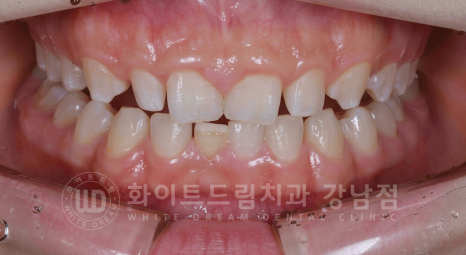 강남역 라미네이트 "치아가 작고 벌어졌어요" 거미스마일 + 벌어진 치아 개선 관련 이미지 3